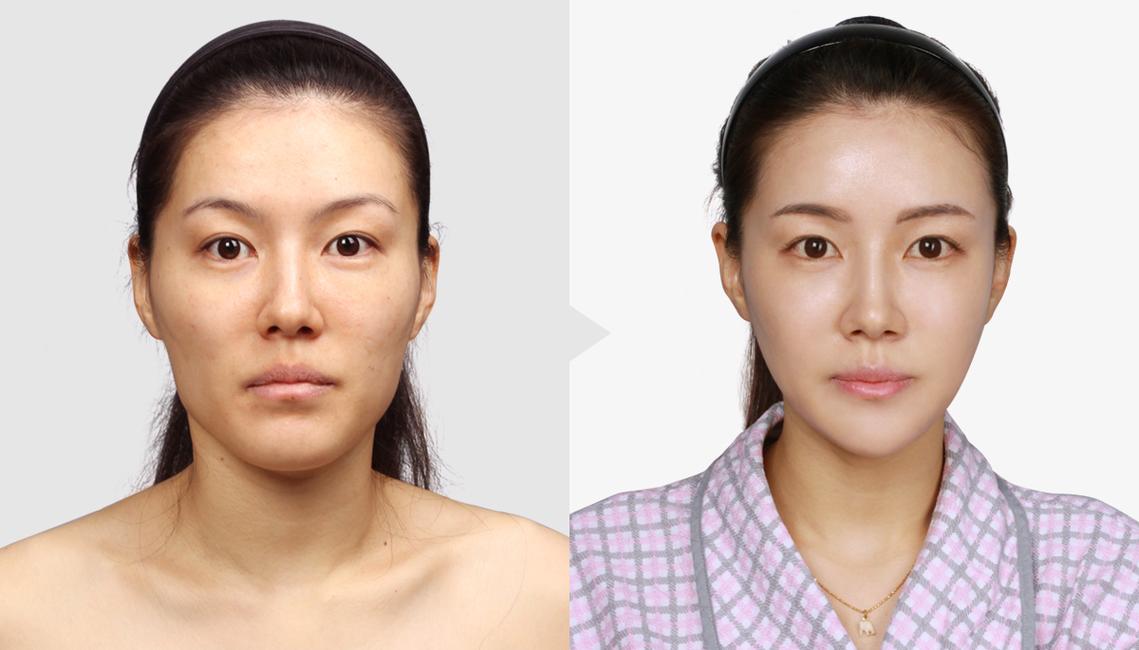 整容對比，深度探討整容前后的差異與影響，深度探討，整容前后的差異與影響分析