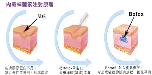 肉毒素除皺的副作用深度解析，肉毒素除皺副作用深度解析
