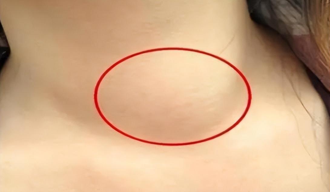 關(guān)于打科興后出現(xiàn)肺結(jié)節(jié)的探討，科興疫苗接種與肺結(jié)節(jié)關(guān)系探討