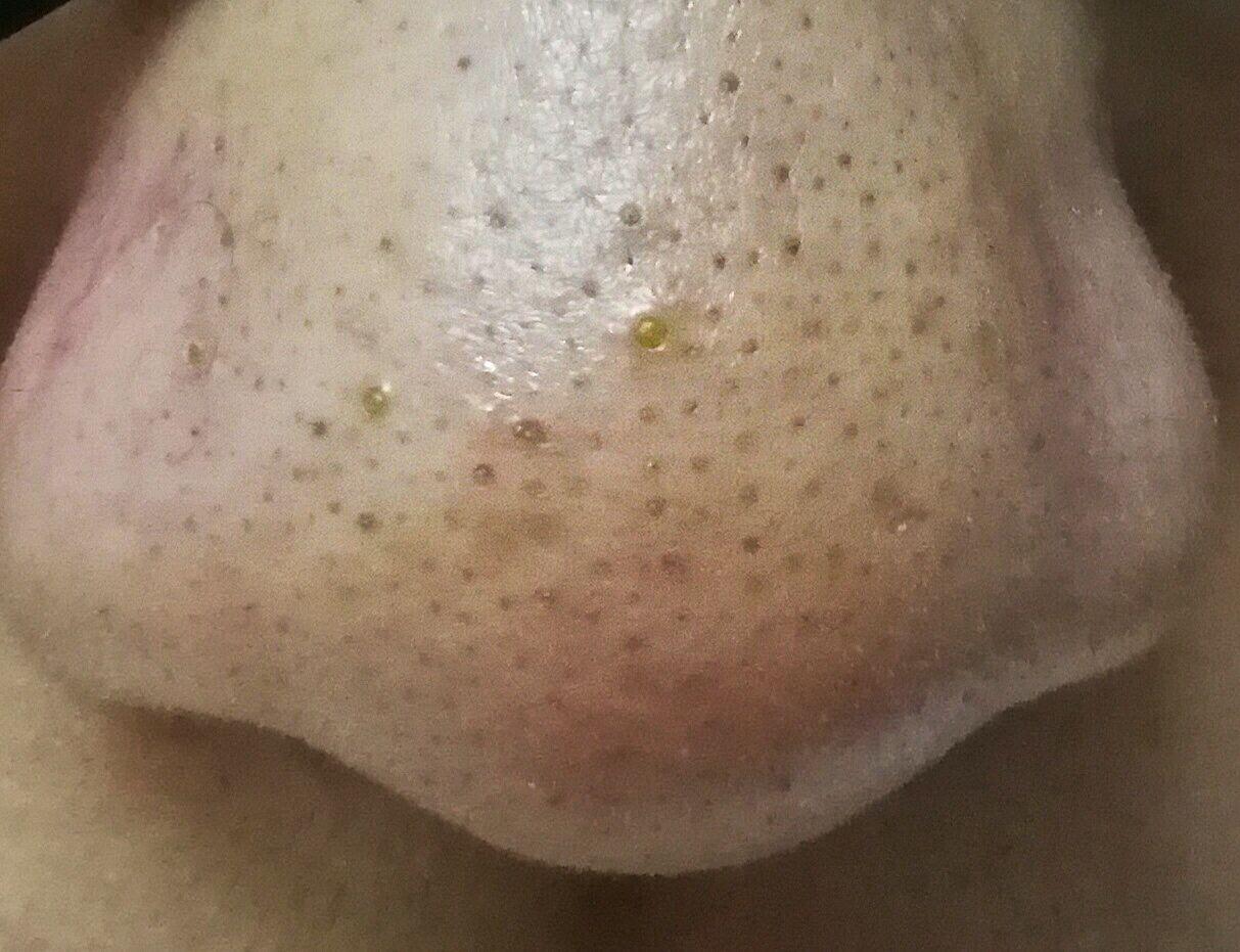如何有效處理黑頭問題——全方位指南，全方位指南，有效處理黑頭問題的方法與策略
