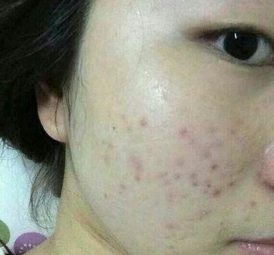揭秘三天快速去痘印小竅門，輕松恢復(fù)肌膚光彩，三天快速去痘印秘訣大揭秘，輕松重塑肌膚光彩