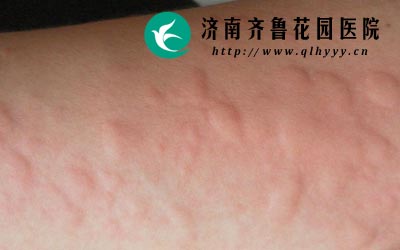 急性蕁麻疹會(huì)傳染嗎？——深入了解急性蕁麻疹的傳染性問題，急性蕁麻疹會(huì)傳染嗎？——探究其傳染性問題