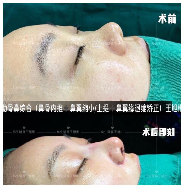 無(wú)需手術(shù)，縮小鼻翼的方法與技巧，無(wú)需手術(shù)縮小鼻翼的方法與技巧